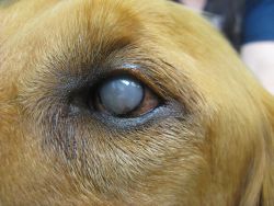 Intraocular Prostheses