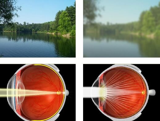 Cataract 