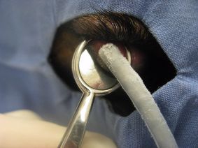 Eyelid Mass