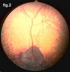 Progressive Retinal Atrophy 