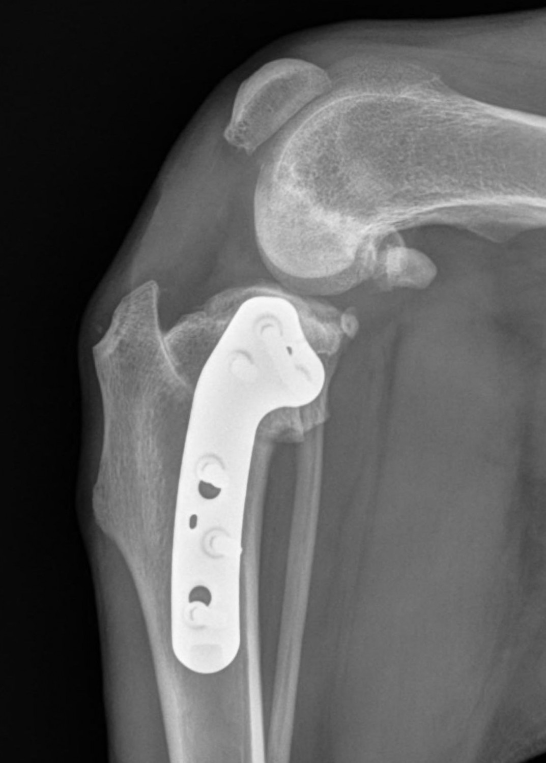 TPLO x-ray